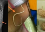 Usus Balita di Jember Penuh Cacing Akibatnya Tak Bisa BAB