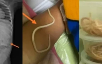 Usus Balita di Jember Penuh Cacing Akibatnya Tak Bisa BAB