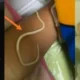 Usus Balita di Jember Penuh Cacing, Akibatnya Tak Bisa BAB