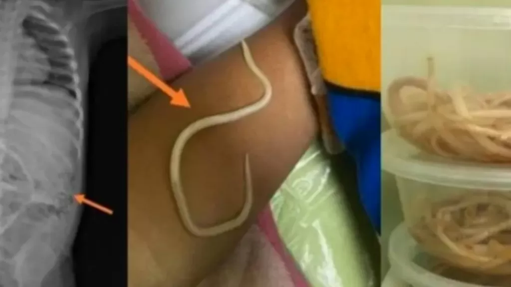 Usus Balita di Jember Penuh Cacing Akibatnya Tak Bisa BAB