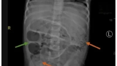 Usus Bocah Jember Penuh Cacing Dokter Ungkap Penyebab Mengejutkan
