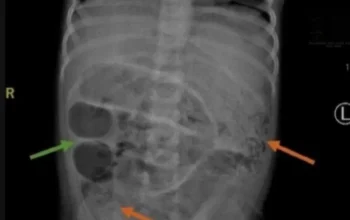 Usus Bocah Tiga Tahun di Jember Penuh Cacing Dokter Ungkap Penyebabnya