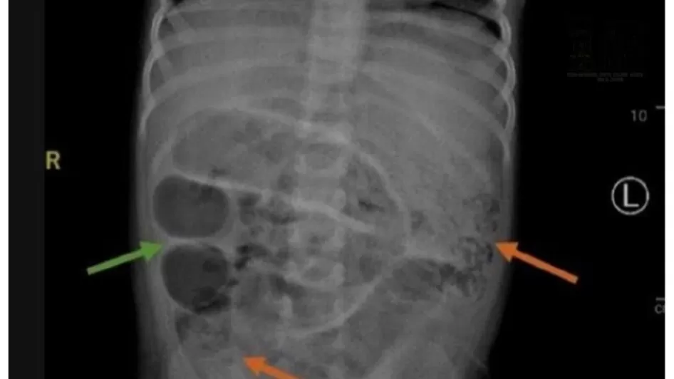 Usus Bocah Tiga Tahun di Jember Penuh Cacing Dokter Ungkap Penyebabnya